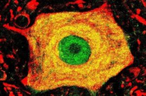 Imagen de una neurona afectada por la ELA