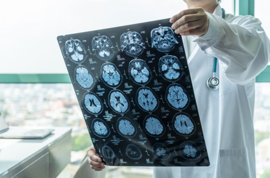 Radiografía del cerebro con ELA y DFT